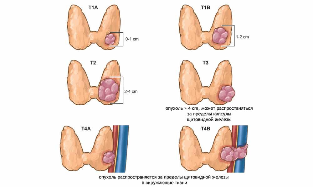 классификация рака щитовидной железы