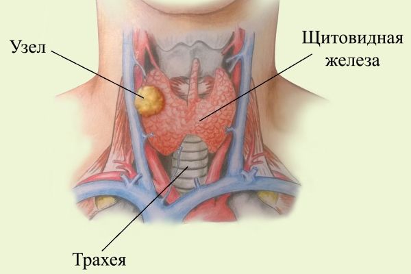 Появление узла при раке щитовидной железы