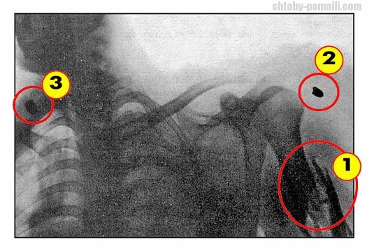 Рентгенограмма верхнего отдела грудной клетки Ленина