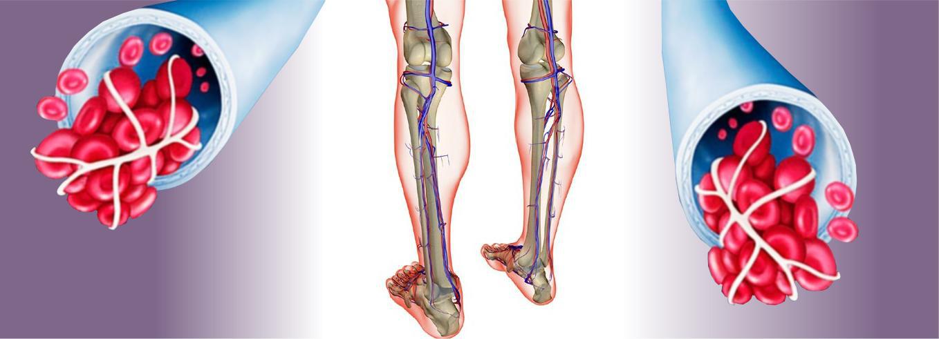 Профилактика тромбоза вен конечностей. Флебит тромбофлебит флеботромбоз. Облитерирующий атеросклероз сосудов ног. Илеофеморальный венозный тромб. Тромбофлебит сосудов нижних конечностей.