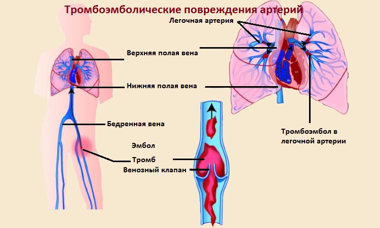 Тромбоэмболия артерий конечностей. Тромбоэмболия легочной артерии. Профилактика тромбоэмболии легочной артерии. Тромбоэмболия легочной артерии рисунок. Тромб в легочной артерии.